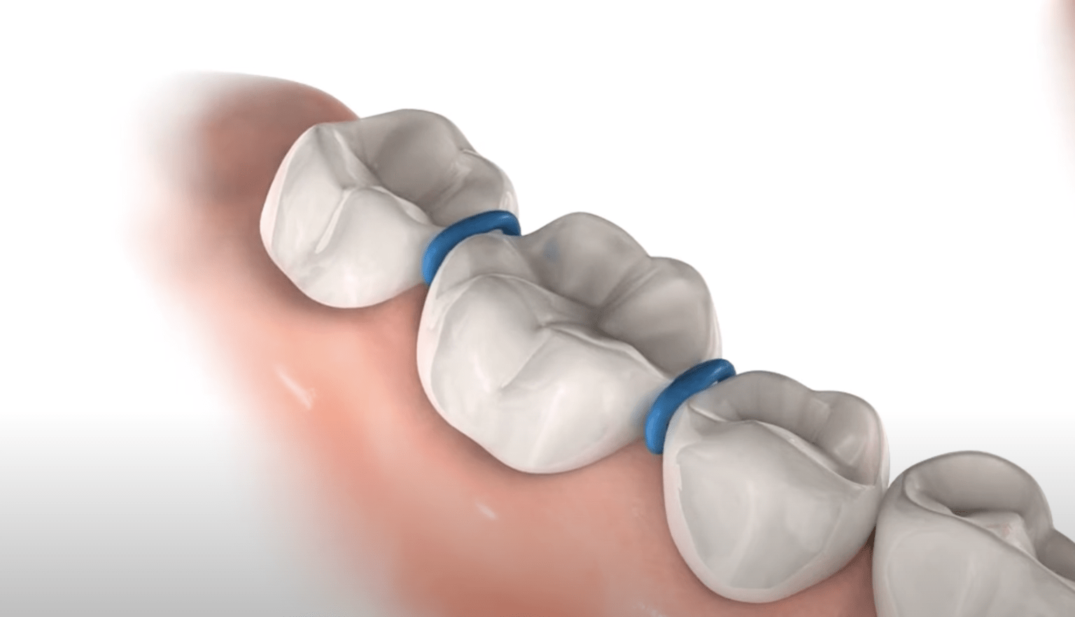 About Your Elastic Separators Pesh Orthodontics