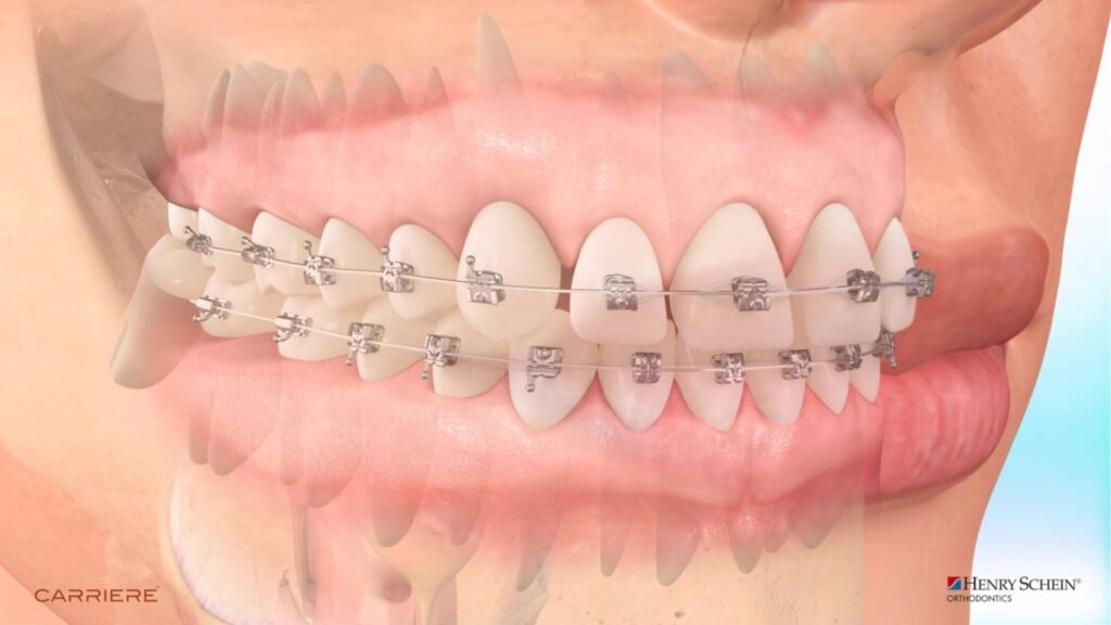 orthodontist retainer menifee