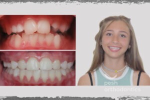 Before and after images of a patient's mouth showing the transformation achieved through orthodontic work by Pesh Orthodontics. The 'before' image displays misaligned teeth, while the 'after' image highlights a beautifully straightened smile, showcasing the effectiveness of the treatment.