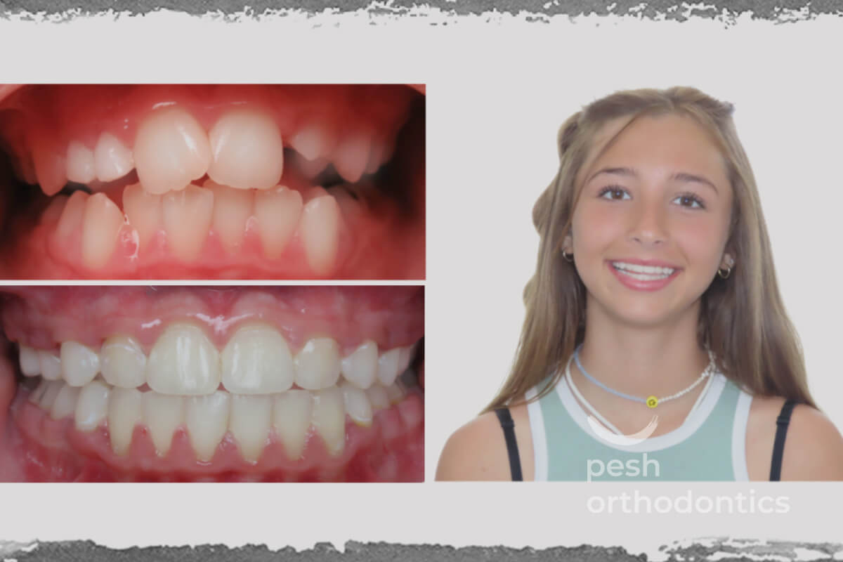 Before and after images of a patient's mouth showing the transformation achieved through orthodontic work by Pesh Orthodontics. The 'before' image displays misaligned teeth, while the 'after' image highlights a beautifully straightened smile, showcasing the effectiveness of the treatment.