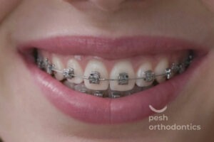 smile braces murrieta