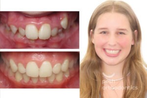 Top and bottom images of a teenager showing the transformation before and after braces. The top image features the teen with crooked and misaligned teeth, while the bottom image displays a confident smile with straight, well-aligned teeth after treatment.