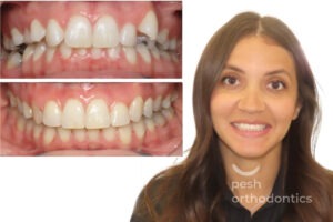 Before and after photo of an adult patient’s smile transformation with braces at Pesh Orthodontics in Menifee and Murrieta, CA